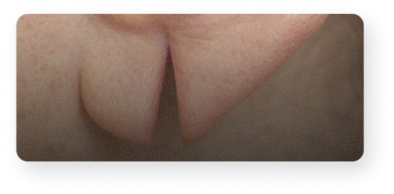 Lobe d’oreille fendu